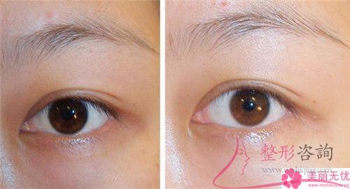 利用干細胞<a href=http://www.f3bb6.cn/listinfo-614-0.html target=_blank class=infotextkey>除皺</a>抗衰能起作用嗎