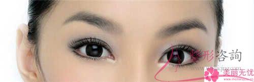 割<a href=http://www.f3bb6.cn/listinfo-724-0.html target=_blank class=infotextkey>雙眼皮</a>手術不理想情況有些什么