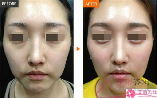 平常的<a href=http://www.f3bb6.cn/listinfo-614-0.html target=_blank class=infotextkey>除皺</a>抗衰成效,鋸齒線懸掛去皺方式能不能達到