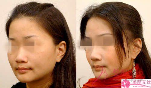 患空鼻緣故有哪些