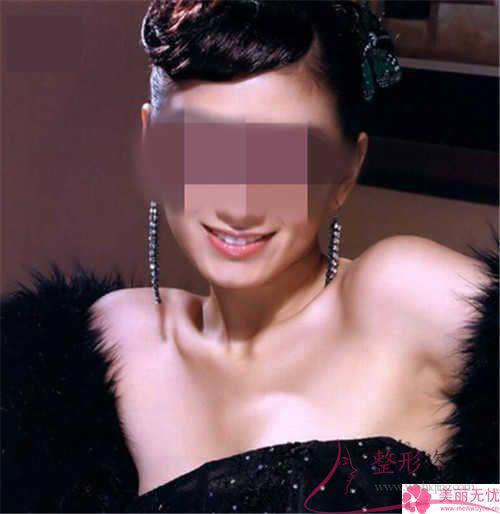 手術方法進行面部提拉對皮膚損害嚴不嚴重