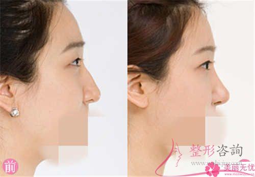 改良蒜頭鼻的整容法子有哪幾個