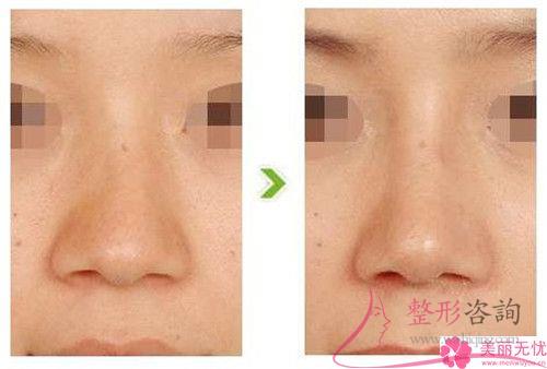 改良蒜頭鼻的整容法子有哪幾個