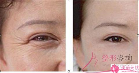 毛孔粗能實行彩光<a href=http://www.f3bb6.cn/listinfo-770-0.html target=_blank class=infotextkey>嫩膚</a>嗎