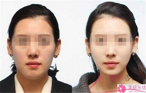 注入<a href=http://www.f3bb6.cn/listinfo-682-0.html target=_blank class=infotextkey>溶脂</a><a href=http://www.f3bb6.cn/listinfo-631-0.html target=_blank class=infotextkey>瘦臉</a>針多長會看到效果