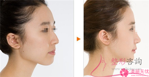 注入<a href=http://www.f3bb6.cn/listinfo-682-0.html target=_blank class=infotextkey>溶脂</a><a href=http://www.f3bb6.cn/listinfo-631-0.html target=_blank class=infotextkey>瘦臉</a>針多長會看到效果