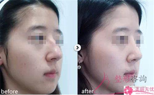 注射奧美定<a href=http://www.f3bb6.cn/listinfo-737-0.html target=_blank class=infotextkey>隆鼻</a>好多錢一回