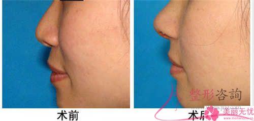 注射奧美定<a href=http://www.f3bb6.cn/listinfo-737-0.html target=_blank class=infotextkey>隆鼻</a>好多錢一回