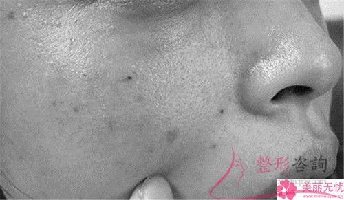 激光祛咖啡斑手術前提因素有哪一些?