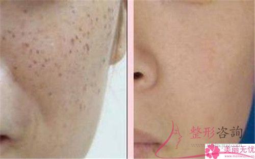 激光祛咖啡斑术必须条件都有几种?