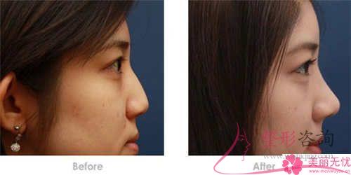 空鼻手術治療效果怎么