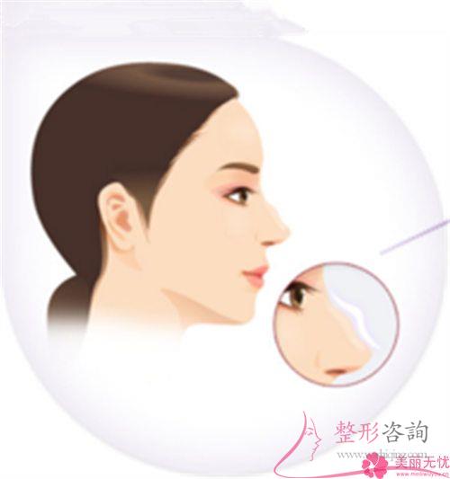 膨體聚四氟乙烯<a href=http://www.f3bb6.cn/listinfo-737-0.html target=_blank class=infotextkey>隆鼻</a>術靠譜嗎？是否有造成感染？