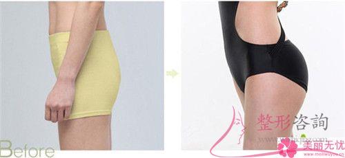 自體組織<a href=http://www.f3bb6.cn/listinfo-677-0.html target=_blank class=infotextkey>豐臀</a>維系的時間長不長