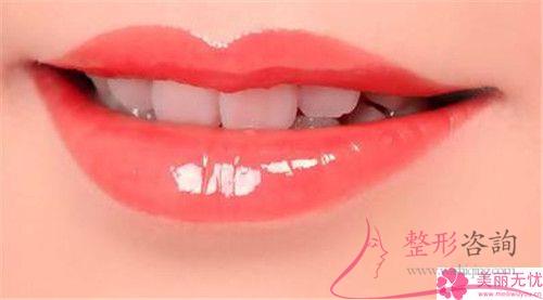 重唇矯治術可以改變哪些問題