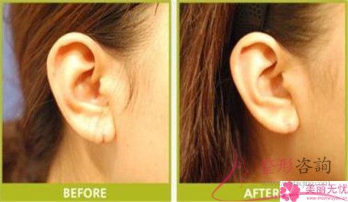 <a href=http://www.f3bb6.cn/listinfo-698-0.html target=_blank class=infotextkey>招風耳矯正</a>手術可以使用免拆除的縫線嗎
