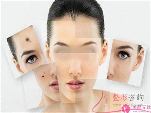 點陣激光祛色斑要經歷多久治療周期