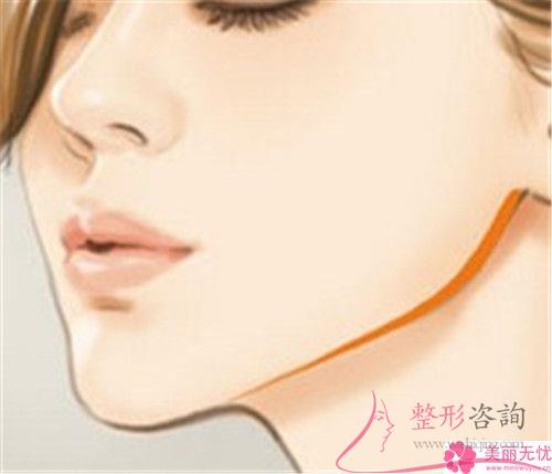 面部深層皺紋打伊維蘭能否快速去除