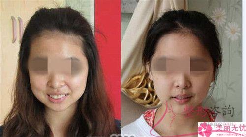 面部深層皺紋打伊維蘭能否快速去除