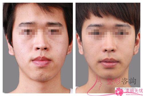 面部深層皺紋打伊維蘭能否快速去除