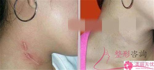 萎縮性疤痕是什么樣子有什么特征呢