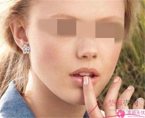 上唇過長影響顏值能不能整形縮短