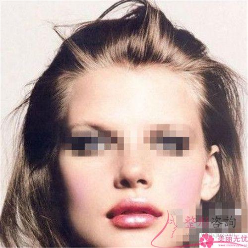 上唇過長影響顏值能不能整形縮短