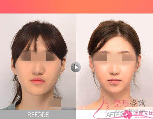 <a href=http://www.f3bb6.cn/listinfo-629-0.html target=_blank class=infotextkey>下頜角</a>手術可以矯正下頜太寬嗎