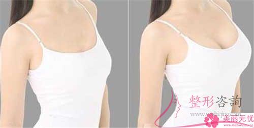 假體<a href=http://www.f3bb6.cn/listinfo-618-0.html target=_blank class=infotextkey>隆胸</a>整形手術費用大約具體是多少?