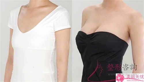 假體<a href=http://www.f3bb6.cn/listinfo-618-0.html target=_blank class=infotextkey>隆胸</a>費用大致是多少？