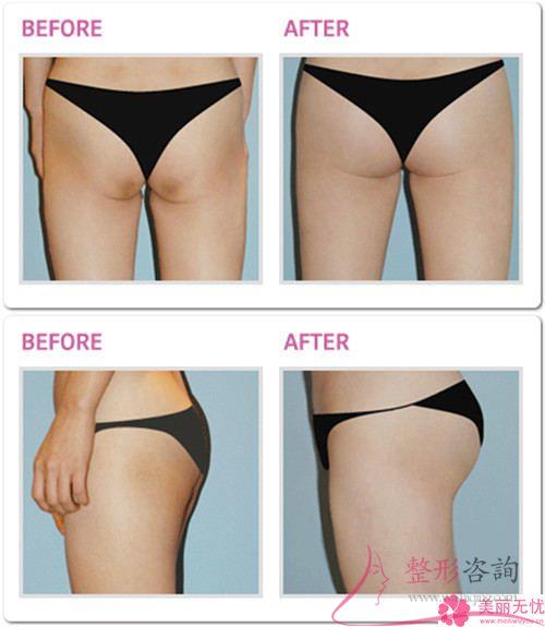 哪些女人可以做自體組織<a href=http://www.f3bb6.cn/listinfo-677-0.html target=_blank class=infotextkey>豐臀</a>術