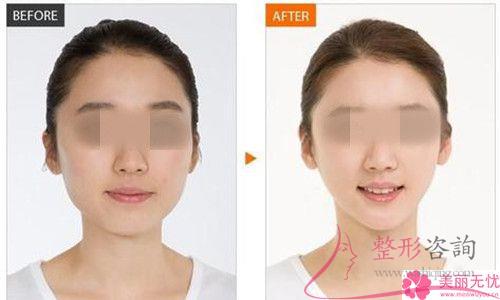 改臉型手術都有哪些方法