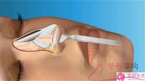 短鼻延長術(shù)通常來說適合于哪種人