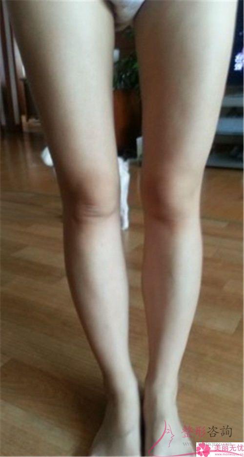 自體脂肪<a href=http://www.f3bb6.cn/listinfo-677-0.html target=_blank class=infotextkey>豐臀</a>術(shù)的4個好處