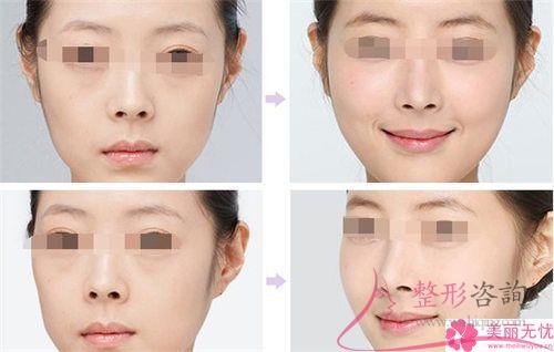 <a href=http://www.f3bb6.cn/listinfo-737-0.html target=_blank class=infotextkey>隆鼻</a>術整形效果有哪些