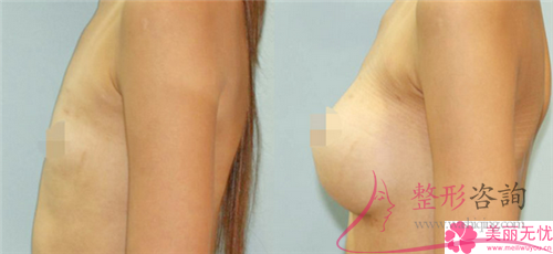 雅靚假體<a href=http://www.f3bb6.cn/listinfo-618-0.html target=_blank class=infotextkey>隆胸</a>合適哪些人群?該如何保養(yǎng)?