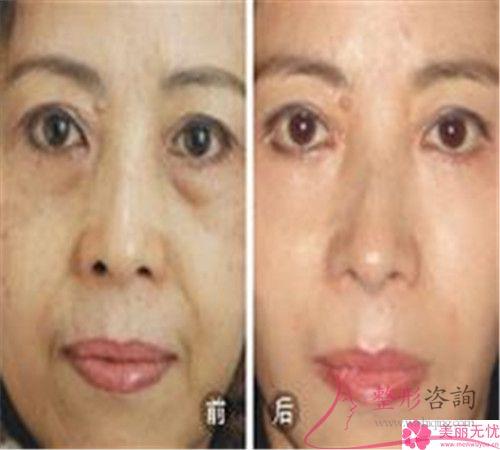 非手術<a href=http://www.f3bb6.cn/listinfo-614-0.html target=_blank class=infotextkey>除皺</a>和手術<a href=http://www.f3bb6.cn/listinfo-614-0.html target=_blank class=infotextkey>除皺</a>貴不貴