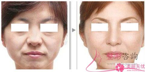 魚尾紋祛除29675足夠嗎？用<a href=http://www.f3bb6.cn/listinfo-610-0.html target=_blank class=infotextkey>熱瑪吉</a>