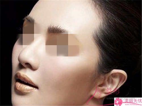 鼻中隔軟骨<a href=http://www.f3bb6.cn/listinfo-737-0.html target=_blank class=infotextkey>隆鼻</a>的費用大概得花多少錢