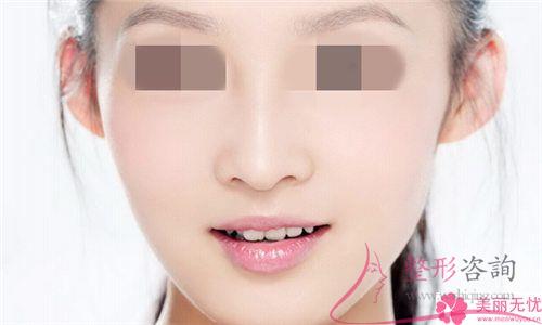 鼻子肥做縮小鼻子變小效果是終身的嗎