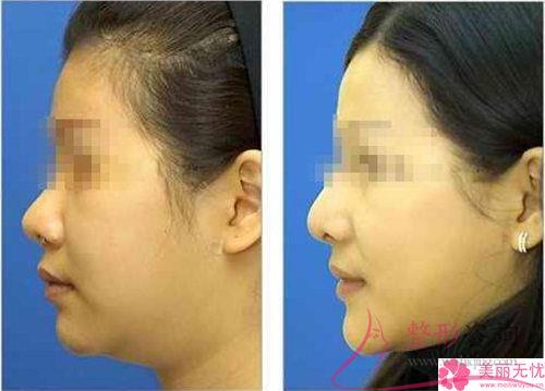 18歲打算隆下巴要準備多少錢