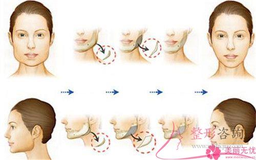 18歲打算隆下巴要準備多少錢