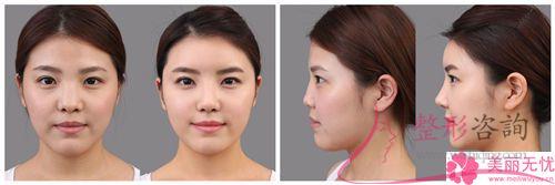 膨體聚四氟乙烯<a href=http://www.f3bb6.cn/listinfo-737-0.html target=_blank class=infotextkey>隆鼻</a>術好長時間會回軟？有并發癥嗎？