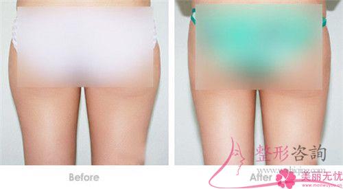 自體<a href=http://www.f3bb6.cn/listinfo-677-0.html target=_blank class=infotextkey>豐臀</a>的優(yōu)點