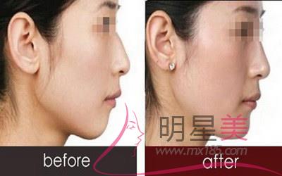 臉上有胎記如何弄掉