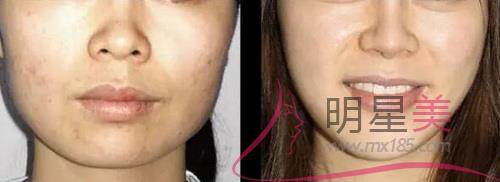 <a href=http://www.f3bb6.cn/listinfo-733-0.html target=_blank class=infotextkey>肉毒素</a>打咬肌注意事項