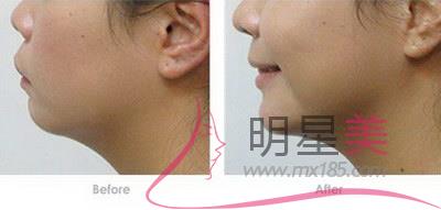 下巴尖疼什么原因