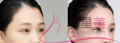 打完<a href=http://www.f3bb6.cn/listinfo-631-0.html target=_blank class=infotextkey>瘦臉</a>臉部凹陷下垂