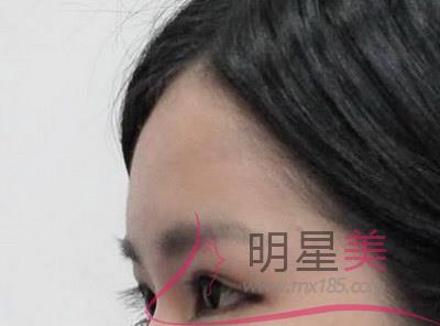 頜骨囊腫手術后25天臉仍腫：長期護理管理指南