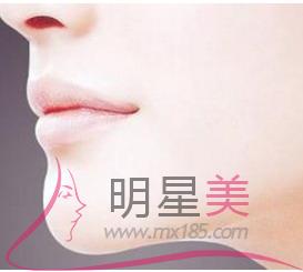 什么是假體豐下巴恢復？