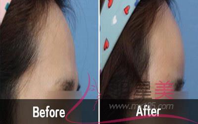 懷孕五個(gè)月臉上長斑了怎么辦